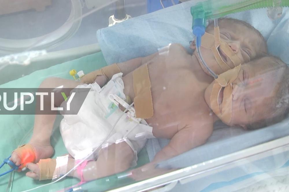Čudo života: Sijamski blizanci rođeni sa jednim telom u Gazi! (VIDEO)