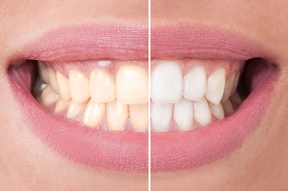 BEZ BOLA I ODLASKA KOD ZUBARA: Izbelite zube sami! Do 2 puta belja boja! (VIDEO)