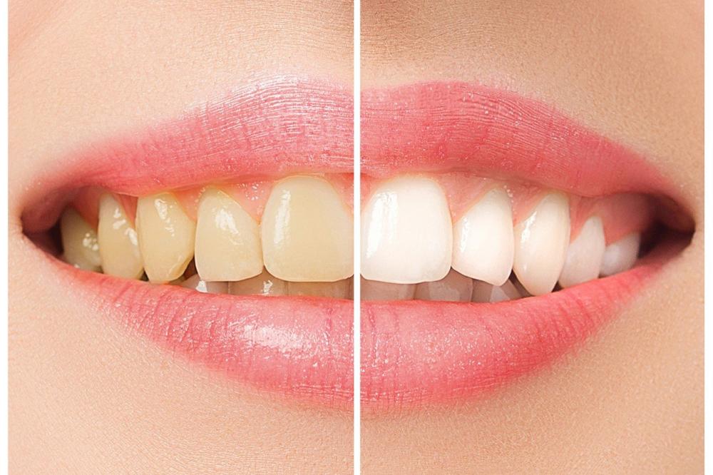 Ne forsirajte izbeljivanje! Žuti zubi su snažniji i zdraviji od belih! (FOTO) (GIF)