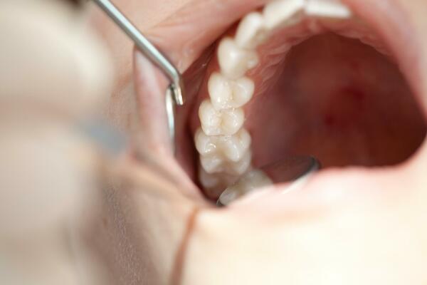 OTIŠAO U TURSKU DA SREDI ZUBE, A ZUBAR GA UNAKAZIO: Šrafom za implant mu PROBUŠIO MOZAK (FOTO)
