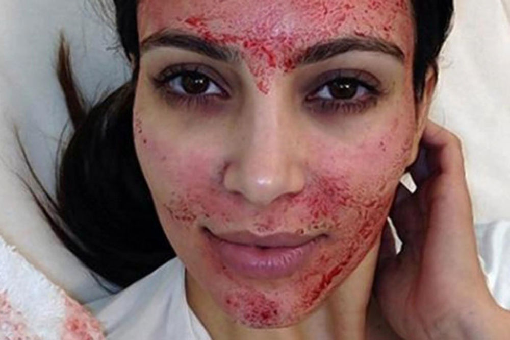 Vampirski tretman: Kim Kardašijan i Anđelina Džoli ubrizgavaju krv u lice! (FOTO)