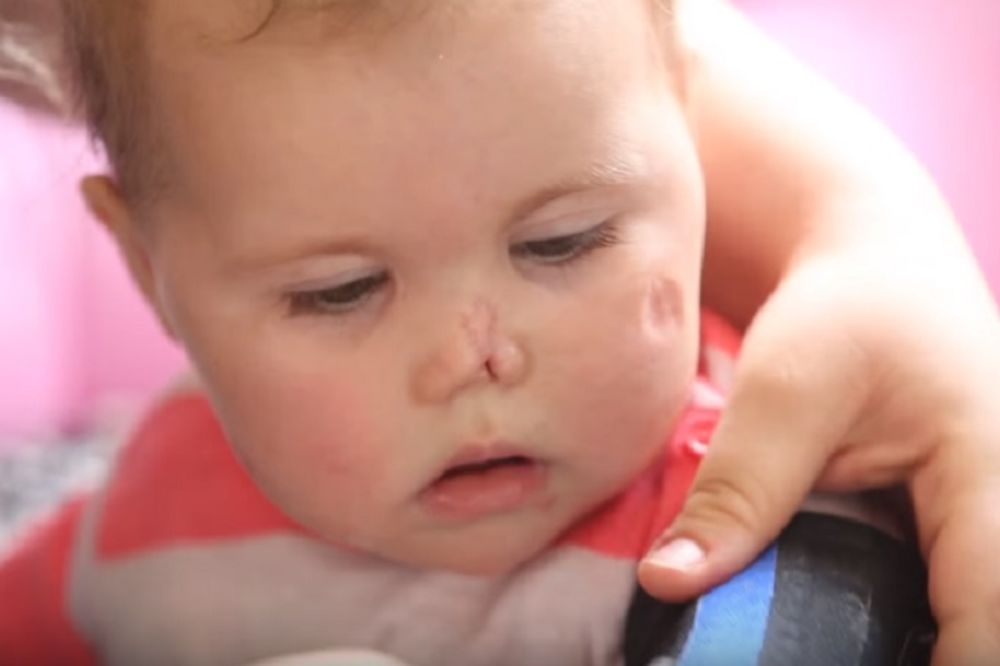Ova beba prošla je kroz pakao. Telo joj se raspadalo, a evo kako izgleda danas! (VIDEO)