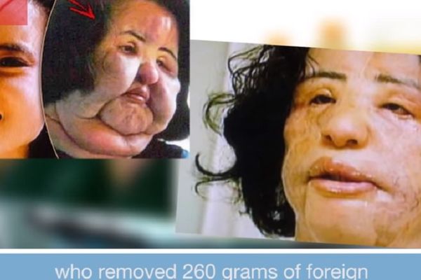 Posle plastičnih operacija ovi ljudi su izgledali zastrašujuće! (UZNEMIRUJUĆI VIDEO)