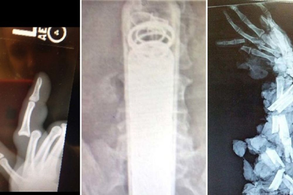 Da li su ovi ljudi normalni? 10 bizarnih rendgen snimaka za nevericu (FOTO)