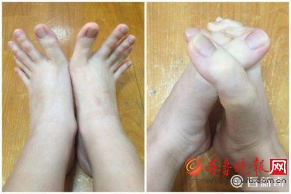 Prstima zbunila ceo svet: Da li su to stopala ili šake? (FOTO)