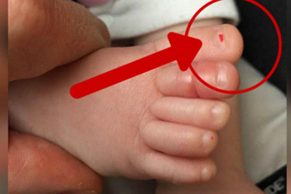Beba je neprestano plakala bez razloga: Onda su roditelji otkrili ovo na njenom nožnom prstu (FOTO)