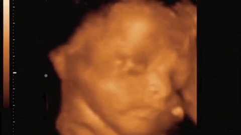 DOKTORI U ŠOKU: 10 dana nakon pobačaja čuli su otkucaje srca u stomaku!? (VIDEO)
