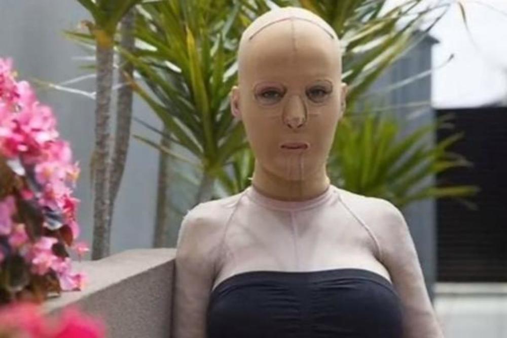 LJUBOMORNA ŽENA JE ŽIVU SPALILA: Srpkinja Dana je 3 godine nosila masku, imala 200 operacija a evo kako izgleda sada (FOTO) (VIDEO)