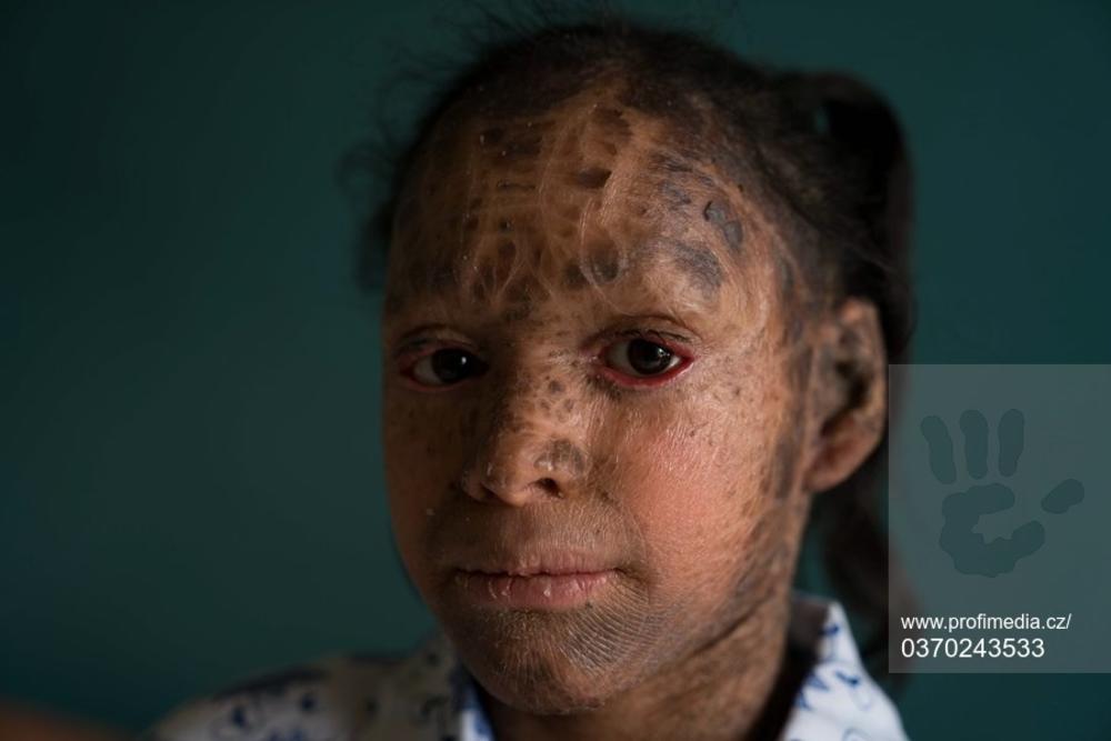 13-godišnjakinja iz Indije pati od genetskog poremećaja pod nazivom ihtioza  