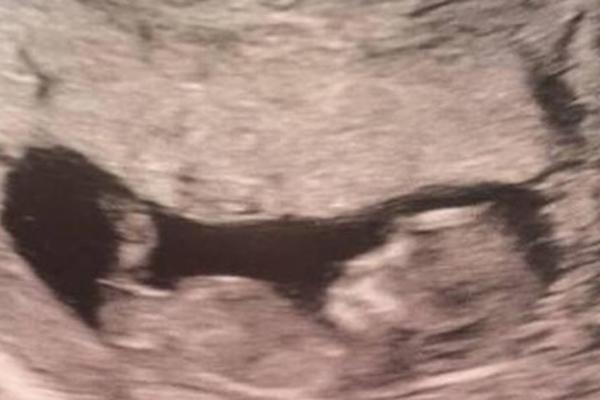 Već na ultrazvuku se videlo da će beba biti DRUGAČIJA od ostalih: Kada se rodila svi su PRIČALI SAMO O JEDNOM (FOTO)