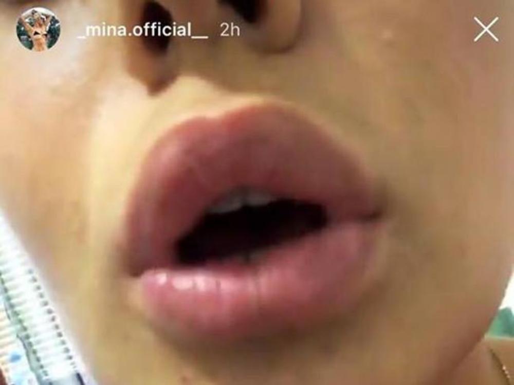 Mina Vrbaški korekcija usana  