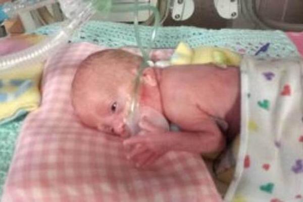 NA ROĐENJU JE IMALA 400 GRAMA: Beba se rodila 4 meseca pre vremena, danas je premašila očekivanja lekara! (FOTO)