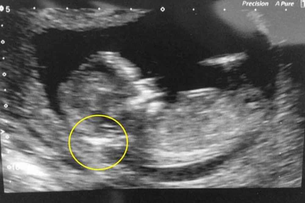 Kad je ginekolog video OVAJ DETALJ na ultrazvuku, rekao mi je da ŠTO PRE ABORTIRAM: Rodila sam i ostala u ŠOKU