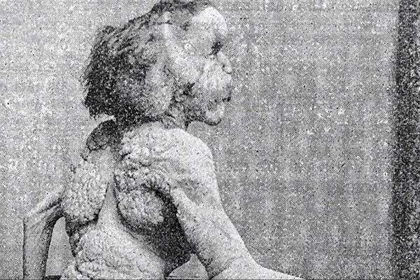 NJEGOVA KOŽA JE BILA DEBELA I KVRGAVA, A GLAVA PREVELIKA: Nakon 130 godina pronađen grob ČOVEKA-SLONA! (FOTO)