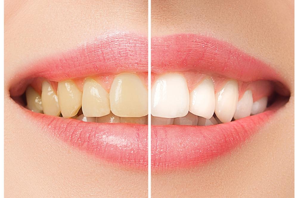 BUDITE PONOSNI NA SVOJ OSMEH: Na ovaj potpuno prirodan način vratićete belinu zubima i oduševiti se rezultatima!