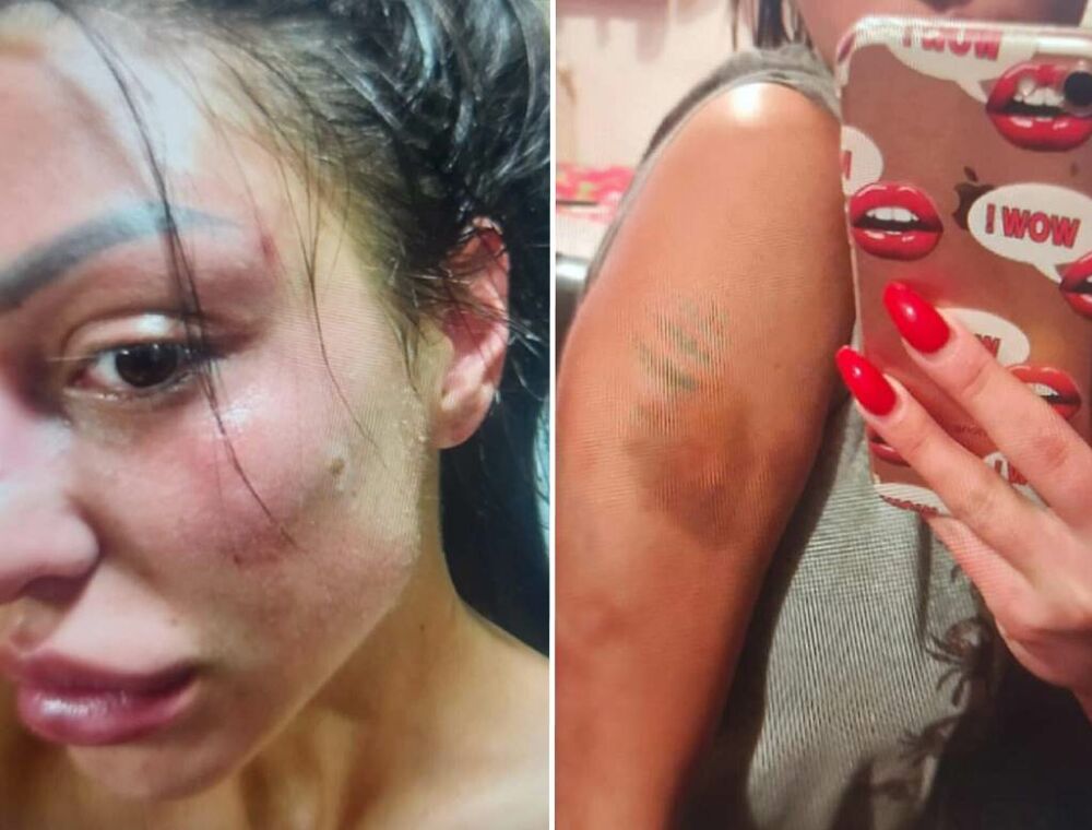 Radomir Marinković Taki, objavio je na društvenoj mreži Instagram ćerkinu fotografiju na kojoj je unakaženog lica, sa podlivima, modricama i sva otečena.