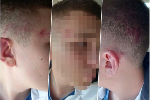 SRPSKOG DEČAKA LAZARA (15) PRETUKLA 4 ALBANCA: Napali ga na ulici u Suvom Dolu dok je peške išao od kuće! (FOTO)
