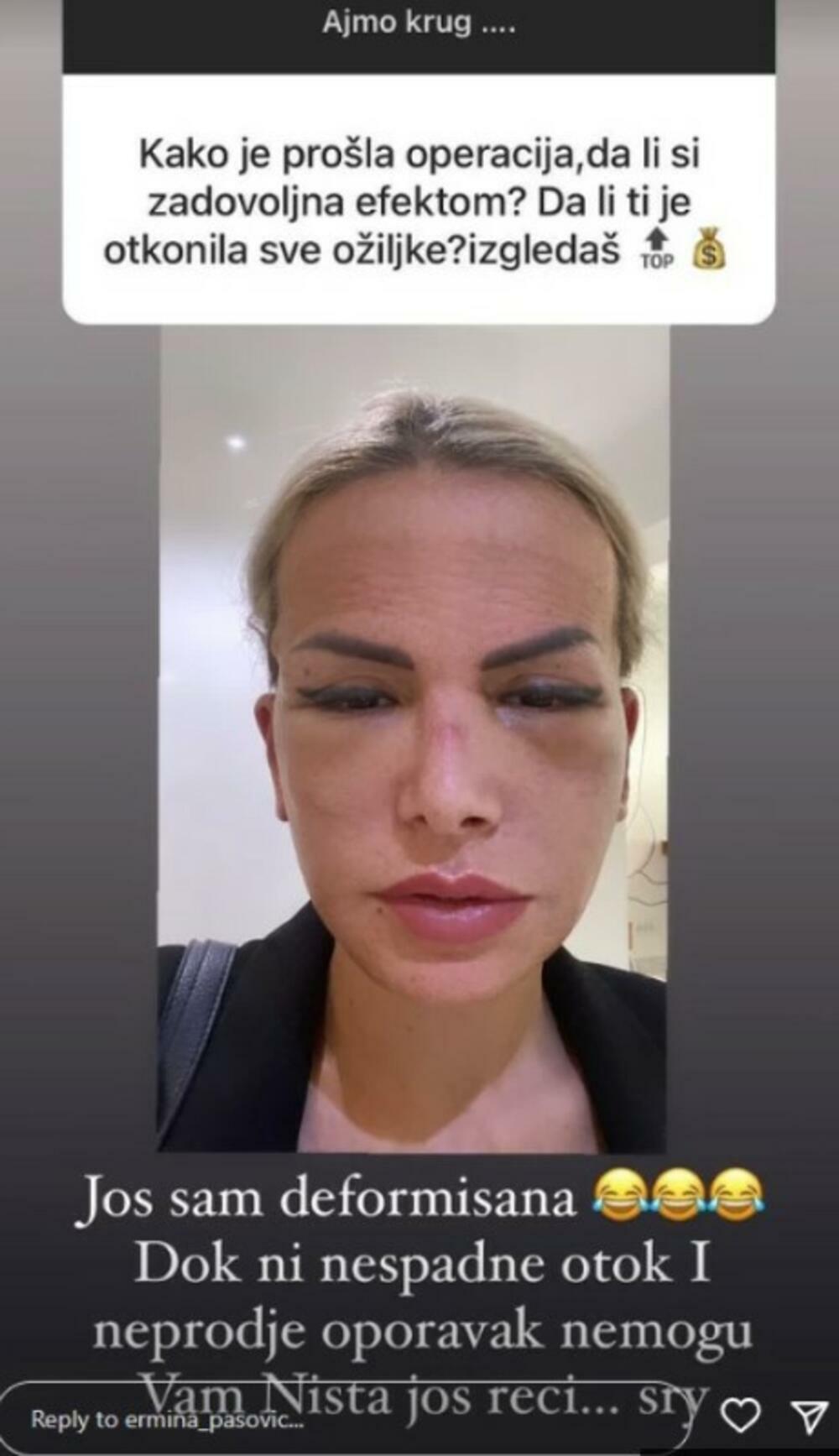 Ermina se operisala i skinula zavoje, a zatim pokazala brojnim pratiocima na Instagramu kako sada izgleda, nakon što je operisala lice